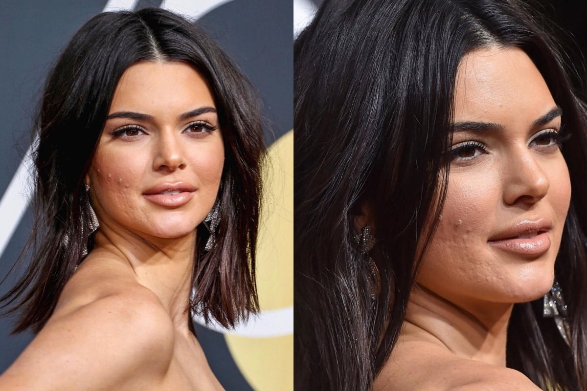 When Kendall Jenner Walked Golden Globes Red Carpet with Visible Acne, See Viral Pics