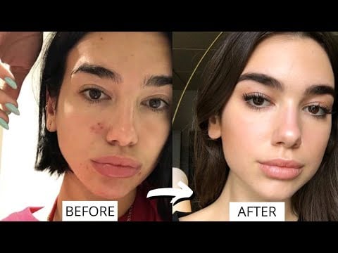 Dua Lipa Home Remedies For Pimples in 2021 - YouTube